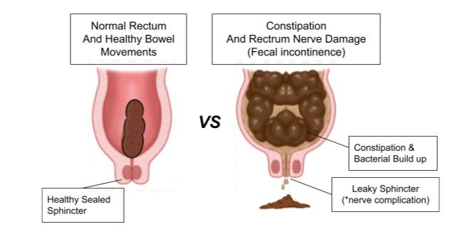 Normal vs Damage Rectum